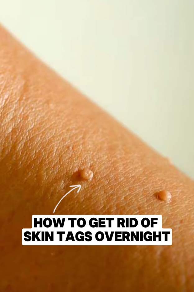 Get Rid of Skin Tags Overnight Using This Natural Method