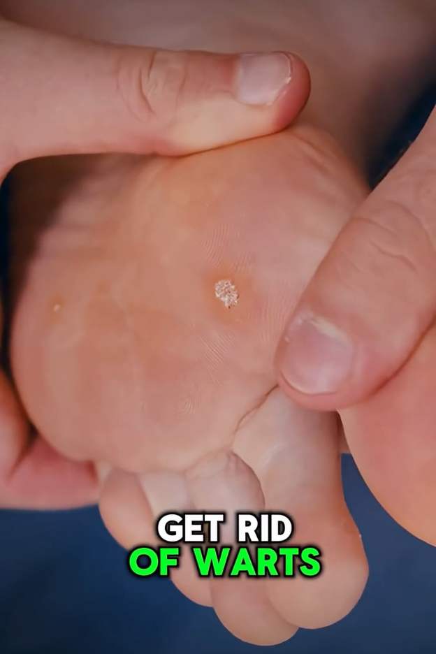 How to Get Rid of Warts Overnight – Natural Home Remedy