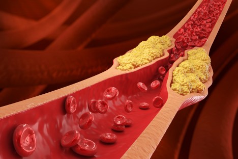 Atherosclerosis concept 