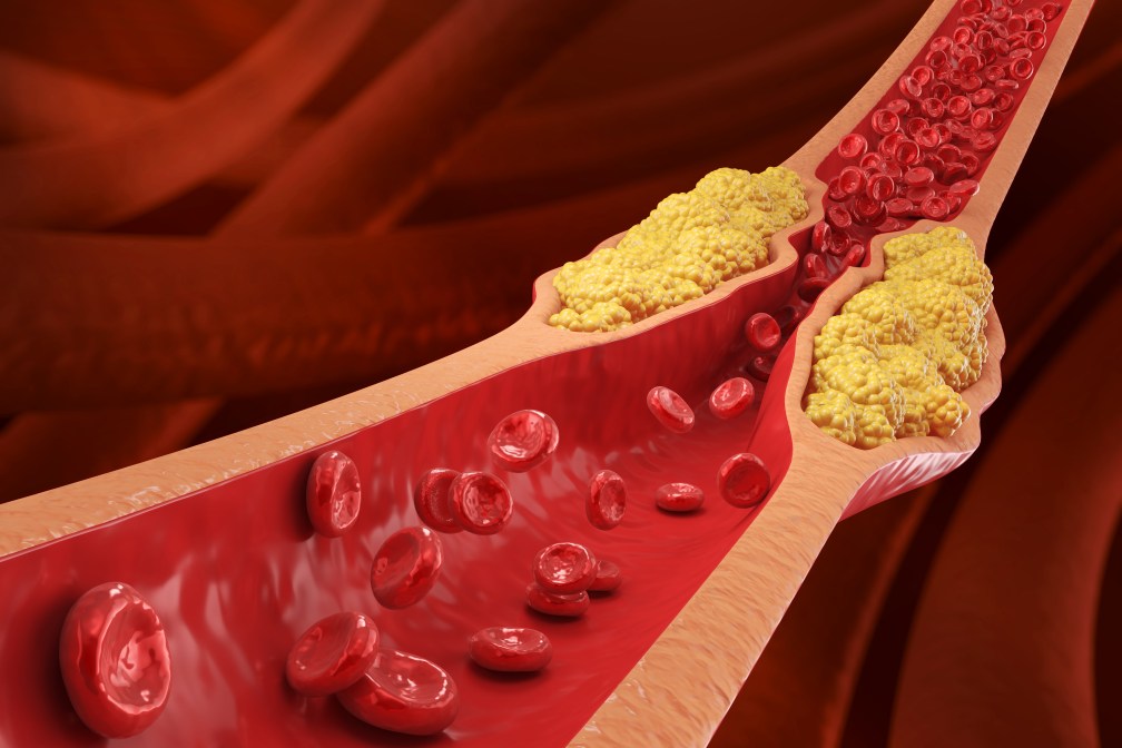 Atherosclerosis concept 